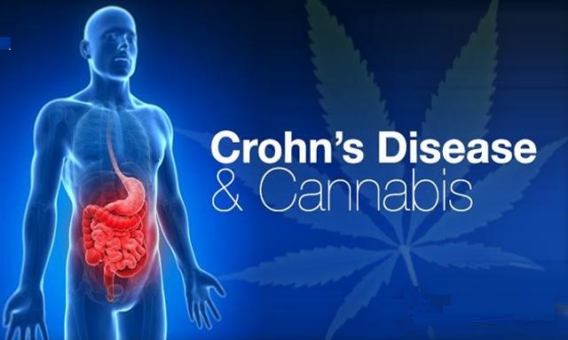 Cannabis treatment for Crohn’s disease