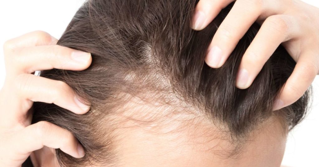 Early Signs of Alopecia