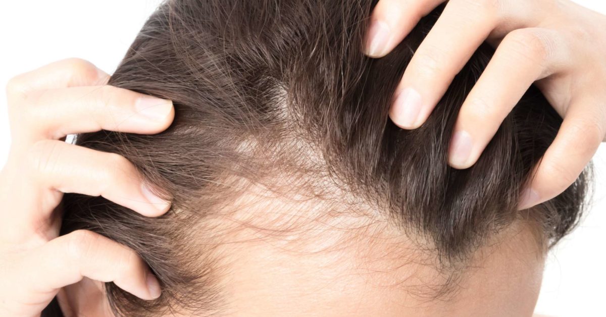 alopecia-areata-treatment-dr-therianou-therianou-md-phd